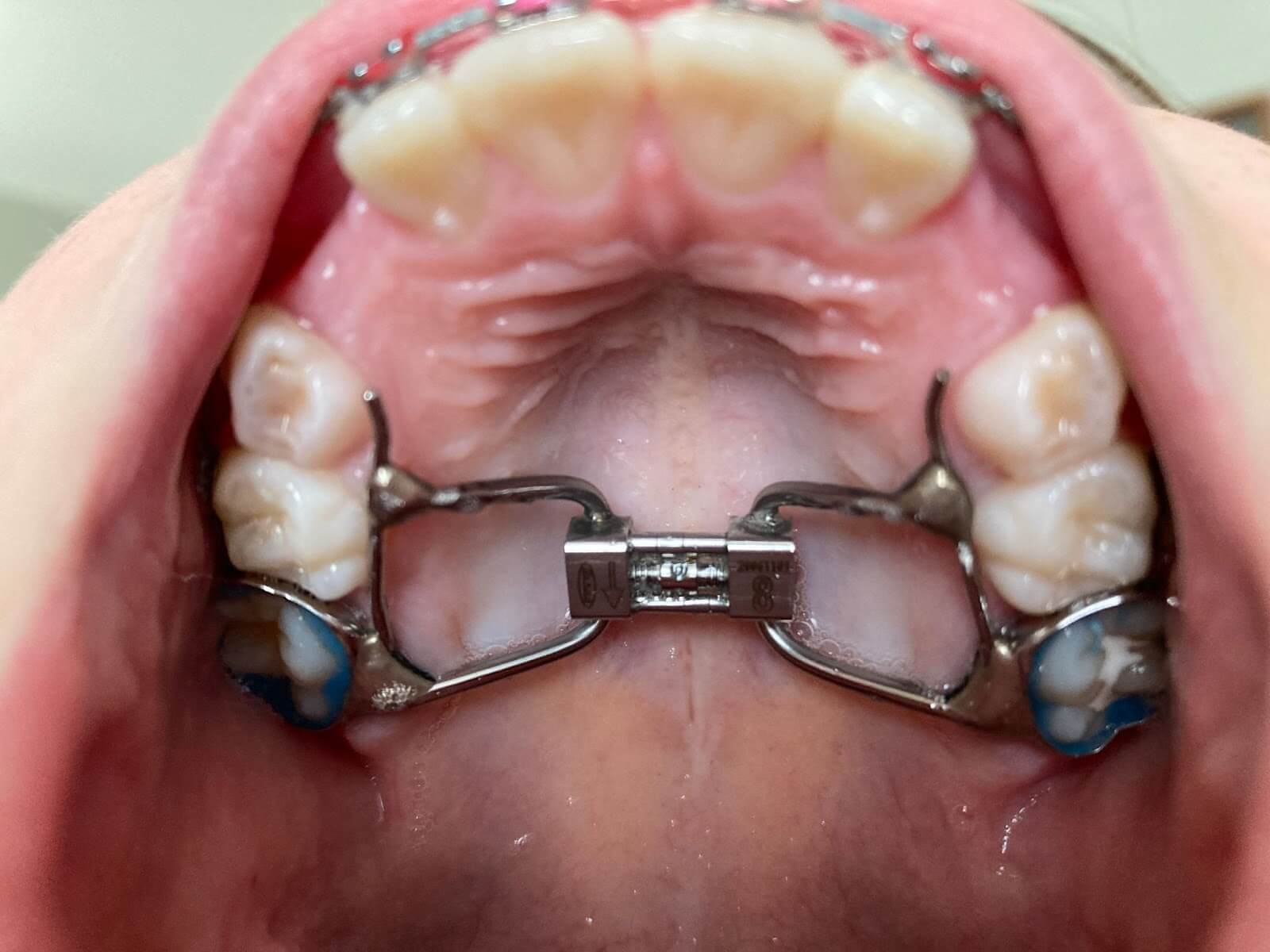 View of Palate expander inside a mouth
