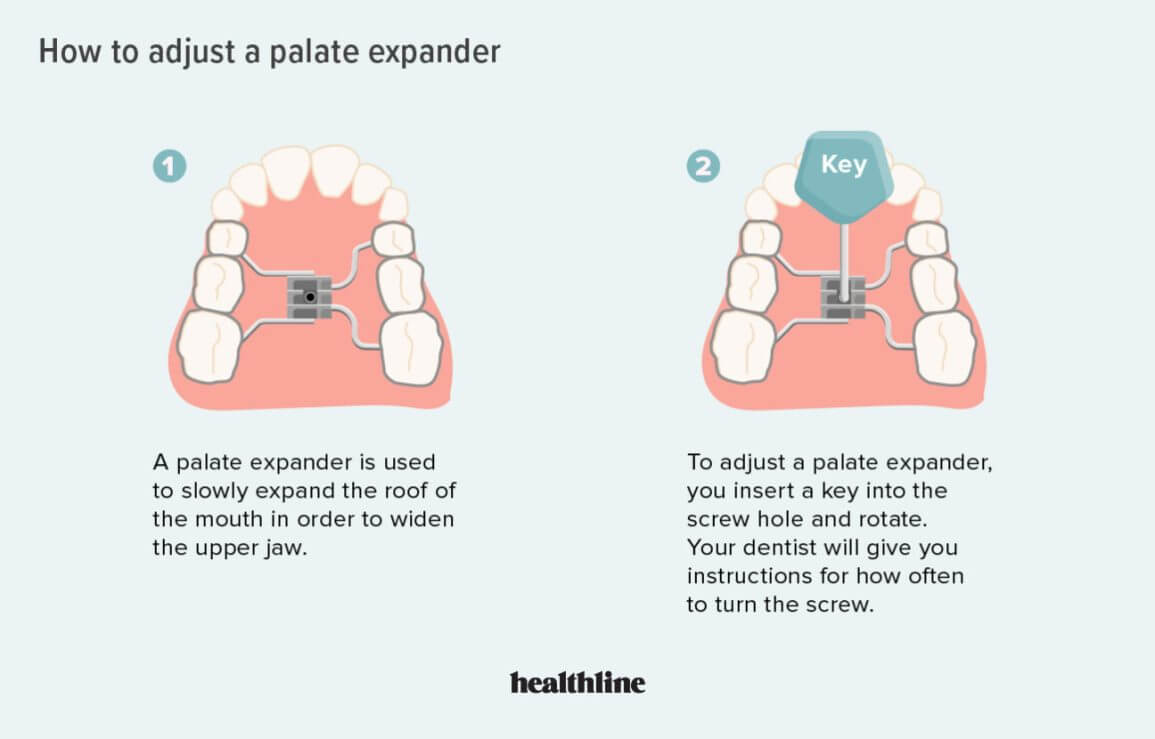 View of Palate expander inside a mouth